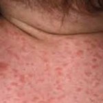 संयुक्त राज्य अमेरिकामा दादुराको प्रकोप, बालबालिका बढी प्रभावित