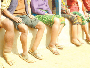 हात्तिपाइले रोग : आठ चरणको औषधिले पनि भेटेन कपिलबस्तुलाई