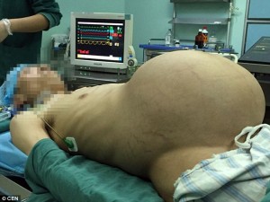 गर्भवती जस्तो देखिएका पुरुषको पेटबाट निकालियो १५ केजी ट्युमर
