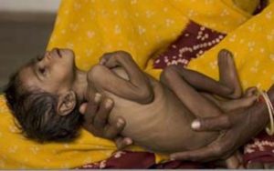 डडेल्धुरा : बालबालिकामा कडा कुपोषण