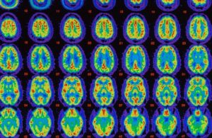 अल्जाइमर बिरामीको स्मरणशक्ति फिर्ता ल्याउन सकिने : नयाँ अध्ययन