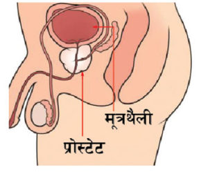 प्रोस्टेट क्यान्सर भएको कसरी थाहा पाउने ? यी हुन् सुरुवाती लक्षण