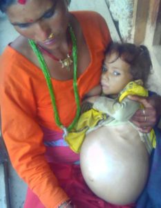 तीन वर्षीया बालिकाको पेटमा ट्युमर
