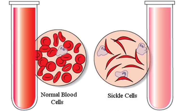 sickle-cell-anemia-test