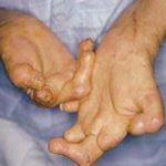 पीडालाई बिर्सेर समुदायमा चेतना फैलाउँदै कुष्ठरोग प्रभावित