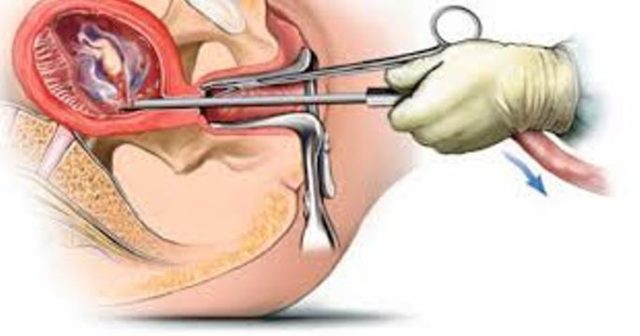 हेटौँडा : सुरक्षित गर्भपतन सेवाप्रति सकारात्मक बन्दै