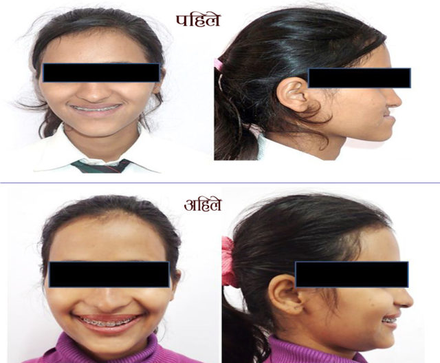 अनुहार सुन्दर बनाउने ‘अर्थोगन्याथिक सर्जरी’ सेवा बीर अस्पतालमा सुरु