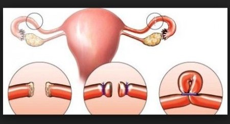 स्थायी बन्ध्याकरण गर्ने महिलाको सङ्ख्यामा भारी वृद्धि