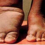 बाँकेमा हात्तीपाइले विरुद्धको १० दिने औषधि सेवन अभियान सुरु