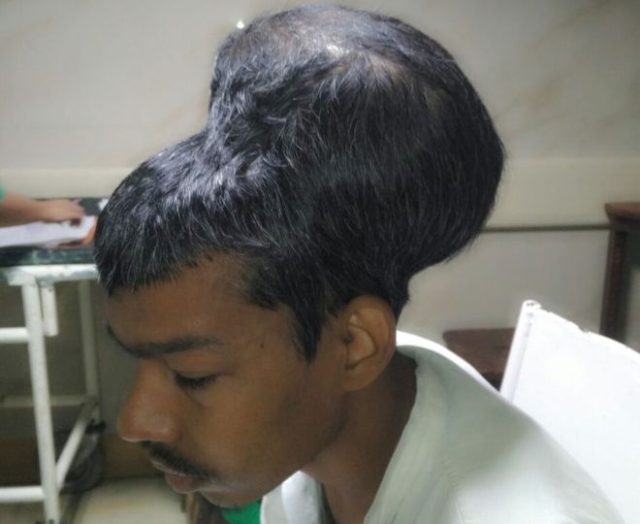 भारतमा ‘संसारकै ठूलो मस्तिष्क ट्युमर’को सफल शल्यक्रिया