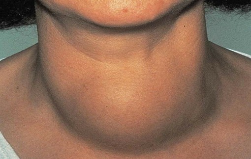 सात वर्षदेखि गलगाँडको भारी बोक्दै विश्राम चौधरी