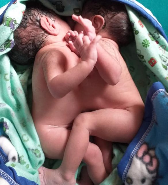 सुर्खेत अस्पतालमा जन्मिए शरीर जोडिएका जुम्ल्याहा शिशु