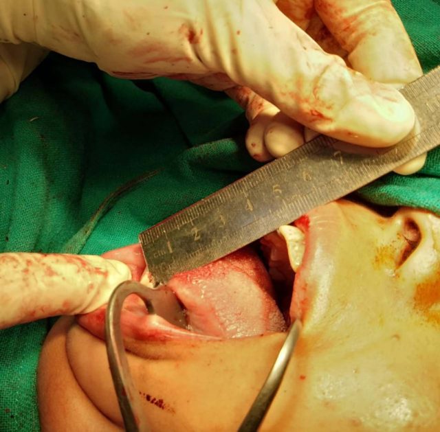 एघार बर्ष अघि बन्द भएको मुख खुलेपछि ……….