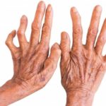 नवलपरासीपूर्वमा ३० कुष्ठरोगीको उपचार हुँदै