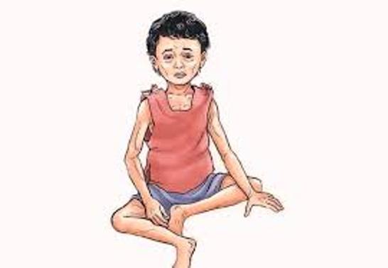 मधेसका १६ प्रतिशत बालबालिकामा कुपोषण