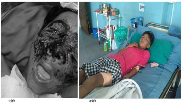 भालुले क्षतविच्छेद गराएको अनुहार म्याक्जिलो फेसियल सर्जरी गरी मिलाईयो