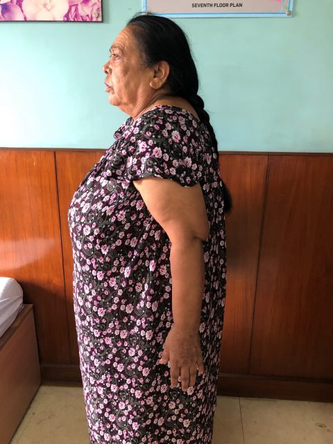 नर्भिकमा तौल कम गर्ने शल्यक्रिया सेवाको सुरुवात