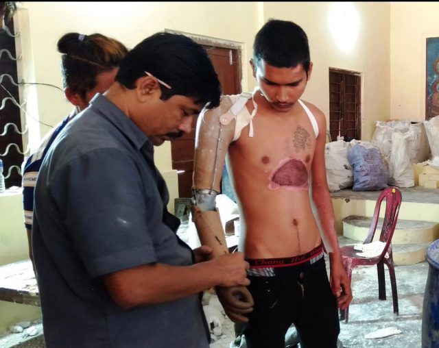 कृत्रिम हातखुट्टा पाउँदा सबै दङ्ग
