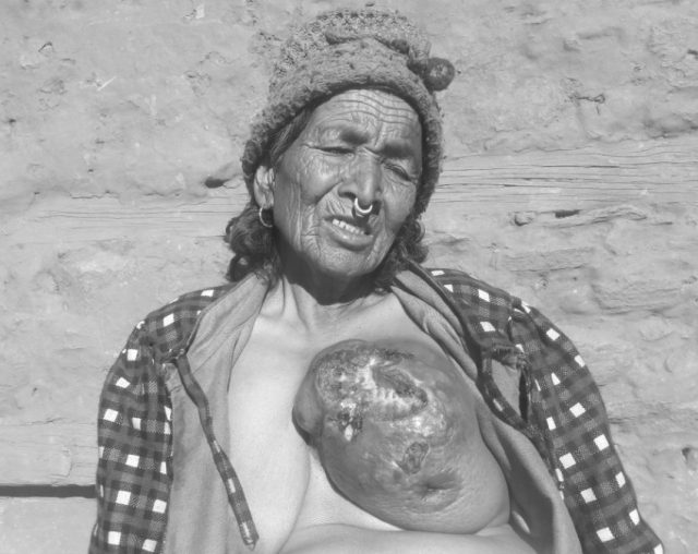 स्तन क्यान्सरले छट्पटिएकी पुम्फाको उपचारको बाटो खुल्यो