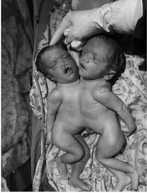 धौलागिरी अस्पतालमा शरीर जोडिएका शिशु जन्मिए