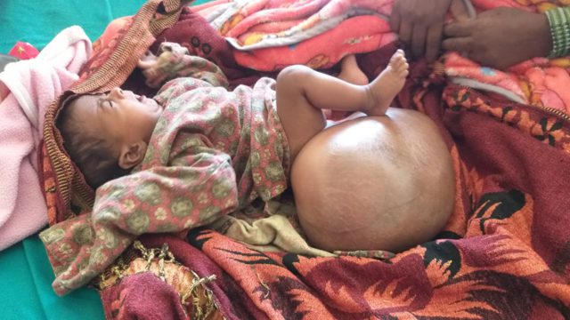 दुई महिनाको शिशुमा पौने चार किलोको ट्युमर, कान्ति अस्पतालमा भयो सफल शल्यक्रिया
