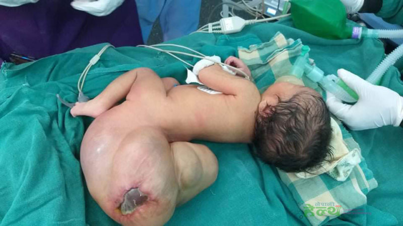 जन्मेको तीन दिनकी एक शिशुको शरीरबाट पौने दुई केजीको ट्युमर हटाइदिएपछि….