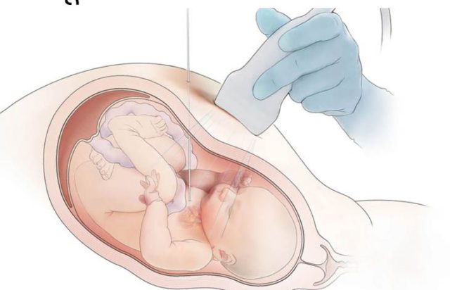 गर्भमा हुर्कदै गरेको शिशुको शल्यक्रिया गरि मुटुको भल्भ खोलियो
