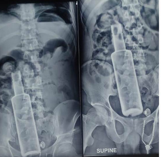 पुरानो मेडिकल कलेजका चिकित्सकहरुले यसरी निकाले नुर्सादको पेटबाट सिसाको बोतल…..