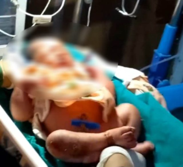 सालनालसहित नवजात शिशु भेटियो