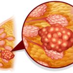 स्तन क्यान्सर उपचारमा नयाँ सम्भावना पत्ता लागेको चिनियाँ अनुसन्धानकर्ताको दाबी