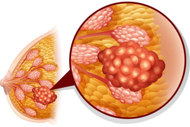 स्तन क्यान्सर उपचारमा नयाँ सम्भावना पत्ता लागेको चिनियाँ अनुसन्धानकर्ताको दाबी
