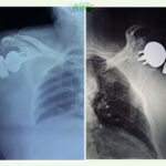 त्रिवि शिक्षण अस्पतालमा पहिलोपटक ‘रिभर्स शोल्डर आर्थ्रोप्लास्टी’ सफल