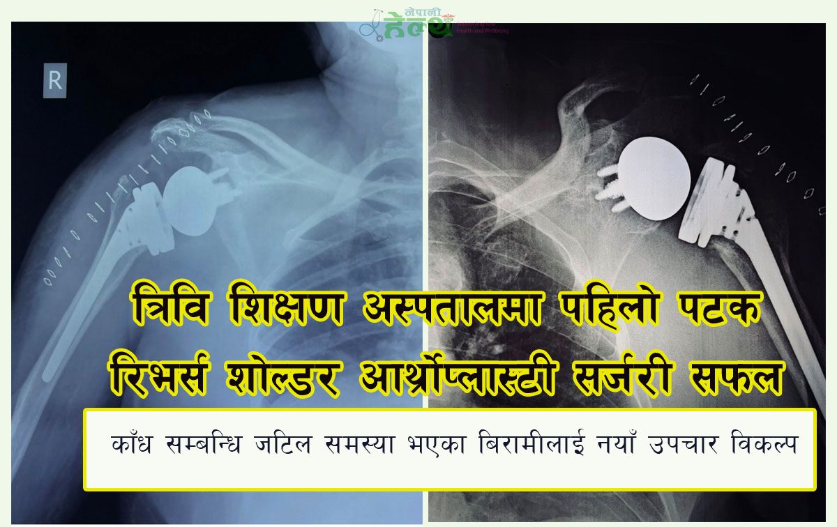 त्रिवि शिक्षण अस्पतालमा पहिलोपटक ‘रिभर्स शोल्डर आर्थ्रोप्लास्टी’ सफल