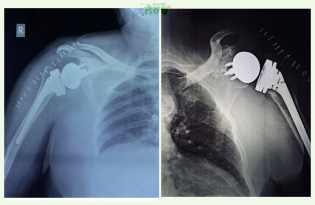 त्रिवि शिक्षण अस्पतालमा पहिलोपटक ‘रिभर्स शोल्डर आर्थ्रोप्लास्टी’ सफल