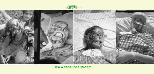 भालुको भयङ्कर आक्रमणबाट बाँचेकी बैतडीकी सुनिता चन्द, खोजी रहेकी छन् सहयोगी मन