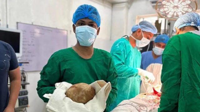 श्रीलङ्कामा एक व्यक्तिको मूत्राशयबाट निकालियो ३.१ केजीको पत्थरी