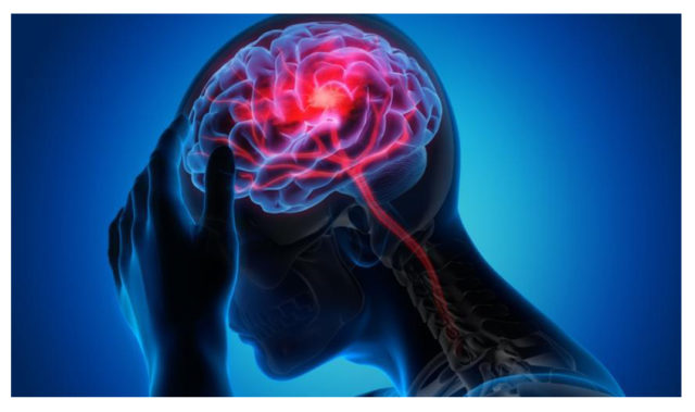 मस्तिष्काघात भएको ७२ घण्टापछि पनि उपचारबाट लाभ हुन सक्ने नयाँ अध्ययनको निष्कर्ष